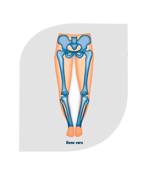 Deformidades-congénitas-angulares-ortopedia-infantil-pediatría-padres-genuvaro-genuvalgo